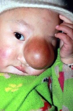 Qin Yuhang, who suffered from a facial tumour that covers his left eye and nose, is pictured before the operation in Huangshan, east Chinas Anhui Province, 2 March 2011 clipart
