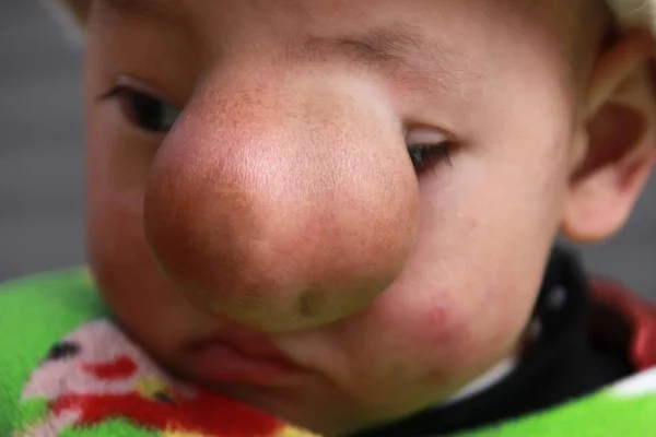 Der Einjährige Qing Yuhang Mit Einem Großen Tumor Auf Der — Stockfoto