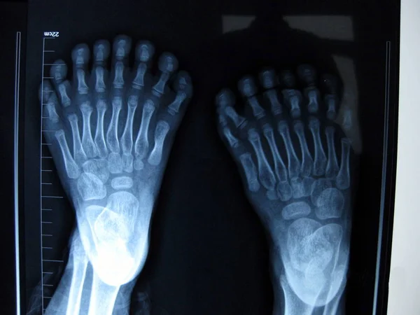 Röntgen Visar Fötterna Årig Pojke Som Har Totalt Fingrar Och — Stockfoto