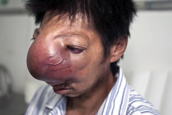 Fei Jianjun Rinerinoma Muzdarip Yaşındaki Bir Adam Changchun Bir Hastanede — Stok fotoğraf