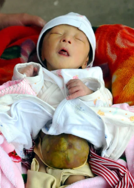 2009年5月9日 星期六 中国四川省南充市金水村的家中 一名新生男婴的内脏通过半透明腹部出现 — 图库照片