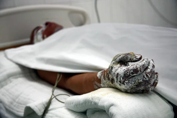 Chinese Man Burned Grassland Fire Receives Medical Treatment Hospital Chengdu — Stock Photo, Image