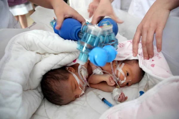 Chinese Verpleegsters Helpen Pasgeboren Siamese Tweelingzussen Ademen Het Bayi Kinderziekenhuis — Stockfoto