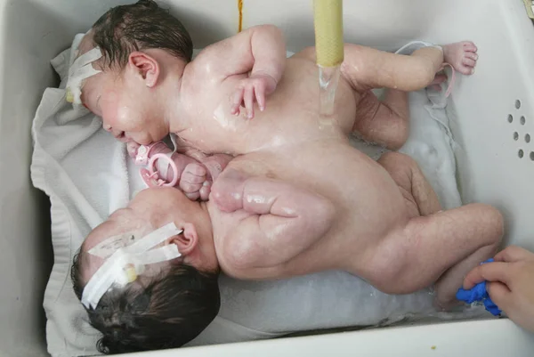Conjoined Twins Lie Bed Successful Separation Operation Childrens Hospital Affiliated — Stock Photo, Image