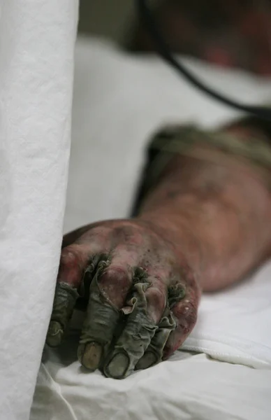 2007年6月11日 中国云南省昆明市一家当地医院 一名重伤的中国矿工躺在病床上 — 图库照片