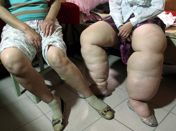 Wang Cheng Destra Anni Che Soffre Linfedema Che Causato Gambe — Foto Stock