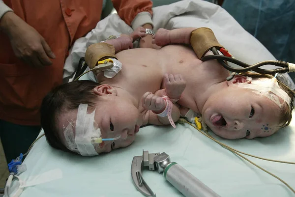 2007年4月6日 上海の復旦大学附属小児病院で分離手術が成功する前に 結合した双子がベッドに横たわっている — ストック写真