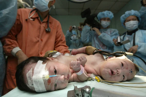 Соединенные Близнецы Лежат Постели Перед Успешной Операцией Разделению Больнице Childrens — стоковое фото