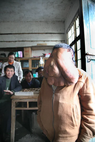 Huang Chuncai Který Trpí Obrovským Nádoru Obličeji Stojí Stolu Svých — Stock fotografie