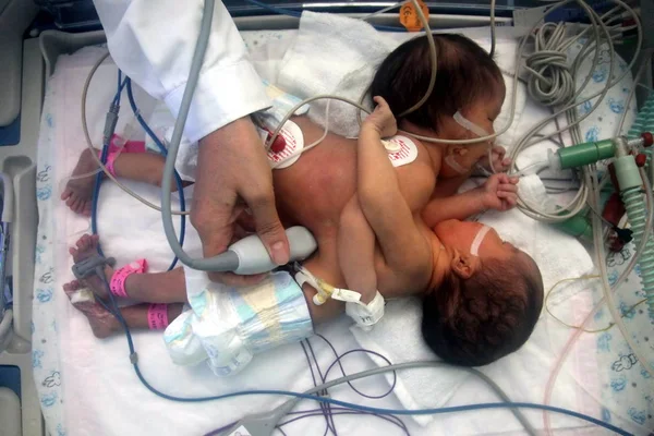 Doctor Examines Newborn Siamese Twin Sisters Kept Incubator Bayi Childrens — Stock Photo, Image