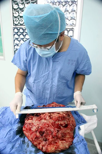 Médico Chinês Medir Enorme Tumor Removido Face Huang Chuncai Guangzhou — Fotografia de Stock