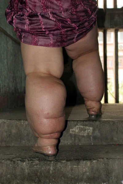 Wang Cheng Who Suffers Lymphedema Which Caused Fat Legs Climbs — Stock Photo, Image