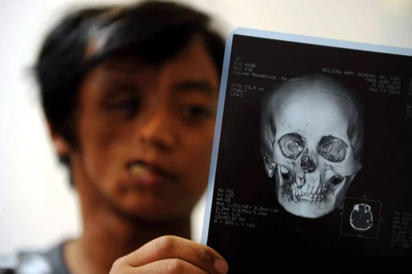 Čínský Muž Suryanem Jang Jehož Tvář Deformovaná Hledí Počítač Který — Stock fotografie