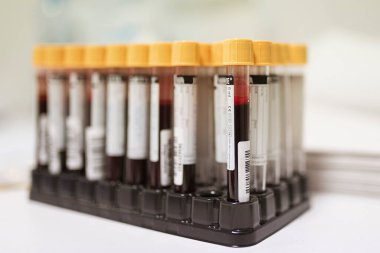 Coronavirus testi için alınan gerçek kan örnekleri.