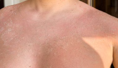 Güneş yanığı, kabuk soyma, yanık, cilt sorunu, baş dönmesi, sağlık, yaz ve güneş. Yüksek kalite