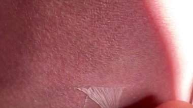 Güneş yanığı üstüne deri soyma, yanmış kırmızı insan derisi, yanıklar, yeni deri. Yüksek 4k kalite