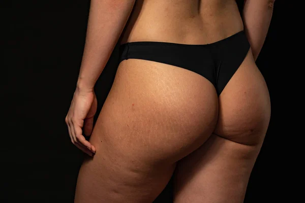 Problem of cellulitis. sports ass on a black background — Stockfoto