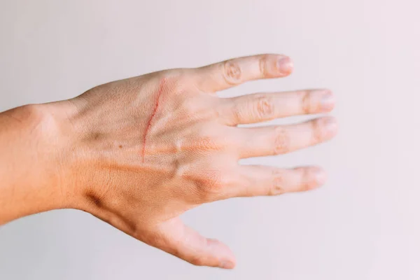 Man\'s hand with big fresh scratch made by cat. Injured arm in animal attack.