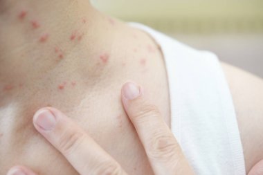 kadın cilt problemleri