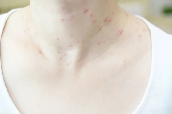 kadın cilt problemleri