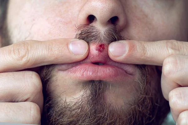 Έρπη Στα Χείλη Του Γενειοφόρου Σοκαρισμένος Άνθρωπος Δείχνει Αιμορραγία Πληγή — Φωτογραφία Αρχείου