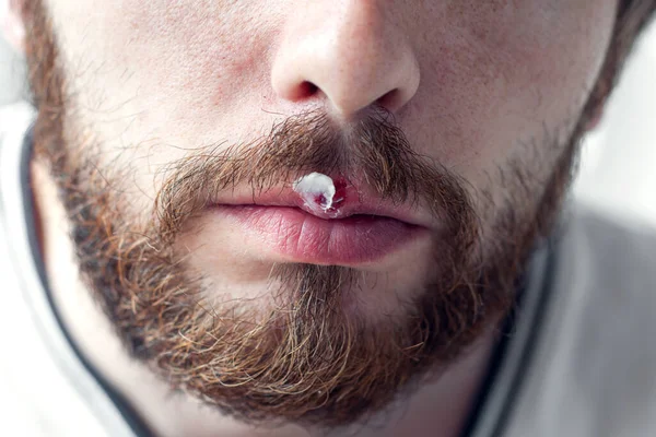 Lower Part Beard Man Face Herpes His Lips Hand Putting — Stock Photo, Image