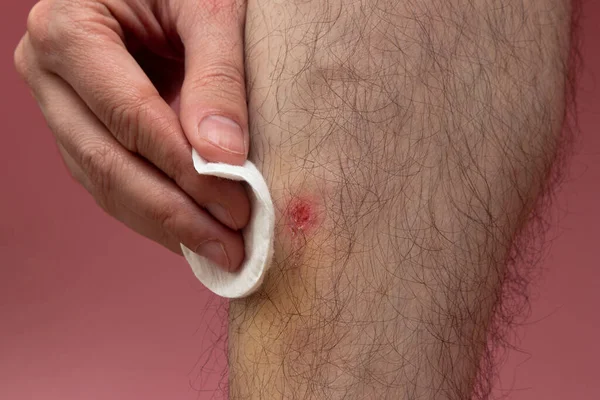 Man Wipes Blood His Lower Leg Cotton Pad Antiseptic — Stock Photo, Image