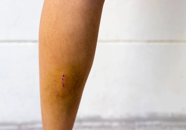 Young Women Have Bruises Legs — Stock Photo, Image