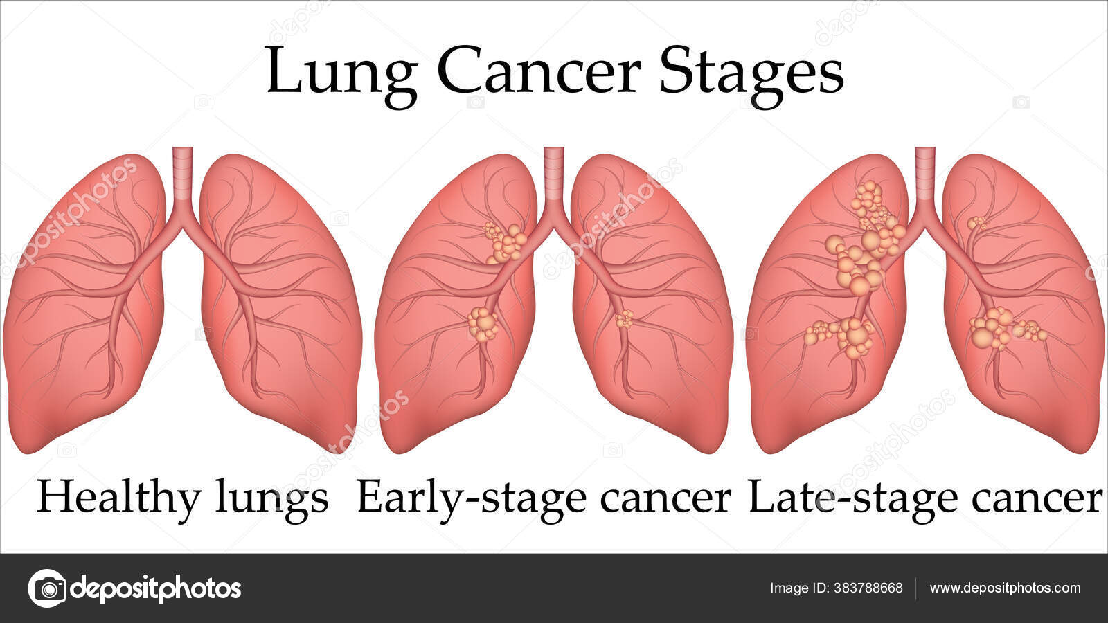 Illustration médicale vectorielle du processus de développement du cancer du poumon humain