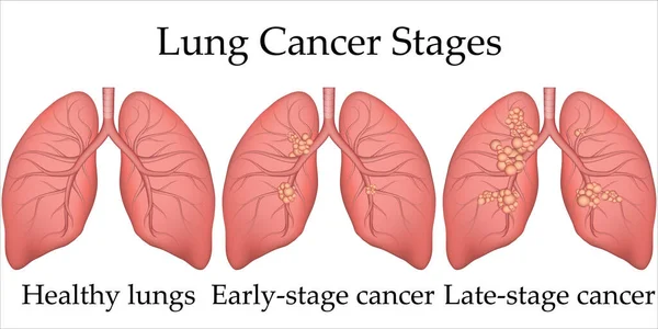 Ilustración médica vectorial del proceso de desarrollo del cáncer de pulmón humano. Estadios del cáncer de pulmón desde los pulmones sanos hasta la última etapa. Póster para hospital o libro de texto de biología . — Vector de stock