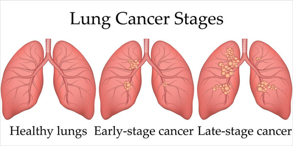 Векторная медицинская иллюстрация процесса развития рака легких человека. Стадии рака легких от здоровых легких до последней стадии. Плакат для больничного или биологического учебника
.