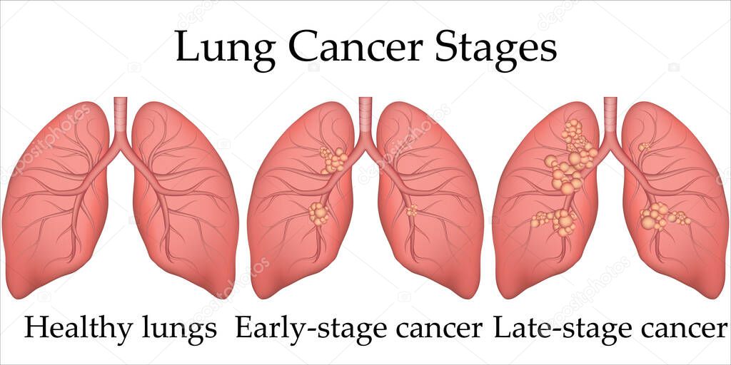 Vector medical illustration of human lung cancer development process. Stages of lung cancer from healthy lungs to the last stage. Poster for hospital or biology textbook.