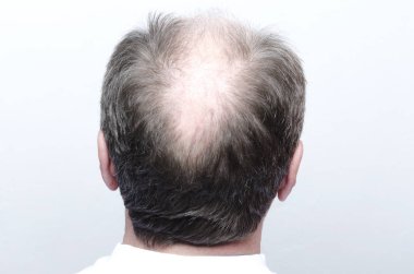 Erkek Kel Kafa arkası. Kellik kavramı