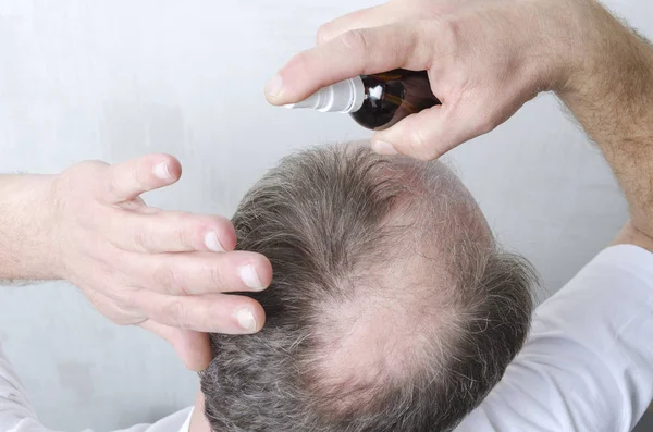 Procedimiento Belleza Para Crecimiento Del Cabello Hombre Tiene Problema Con —  Fotos de Stock