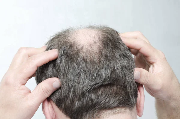 Concept of hair loss.Man doing a head massage as a treatment of receding