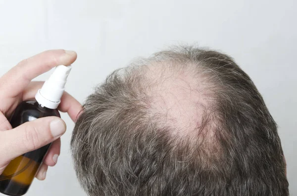 Hombre Usando Cosméticos Para Estimular Crecimiento Del Cabello Concepto Tratamiento —  Fotos de Stock