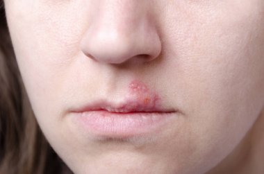 Dudaklarda herpes simpleks yakın çekim. Kadının yüzünün ve dudaklarının yakın çekim