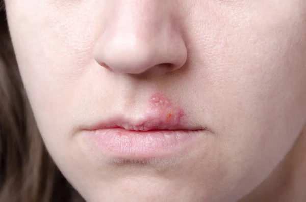 Fechar Herpes Simplex Nos Lábios Fechar Rosto Lábios Mulher — Fotografia de Stock