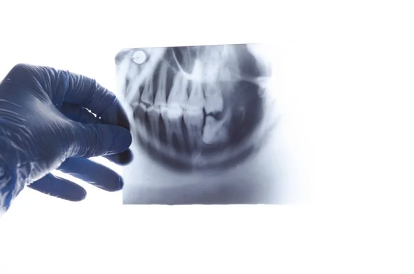 Zahnröntgen Gegen Weißes Bildschirm Problem Weisheitszahn — Stockfoto