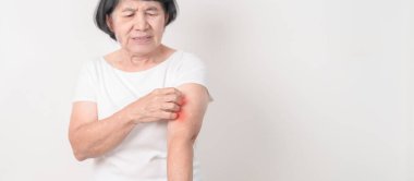 Böcek ısırığı ve yemek dermatiti yüzünden cilt alerjisi için kaşınan yaşlı bir kadın. Dermatoloji, cüzzam günü, sistemik lupus eritematoz, sedef, urtikya ve isilik.