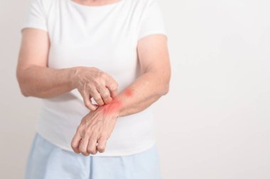 Böcek ısırığı ve yemek dermatiti yüzünden cilt alerjisi için kaşınan yaşlı bir kadın. Dermatoloji, cüzzam günü, sistemik lupus eritematoz, sedef, urtikya ve isilik.