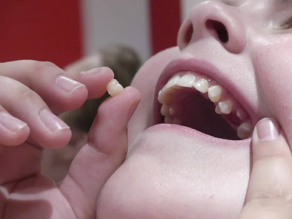 Um adolescente tinha um dente de leite. Adolescente puxa dente de leite . — Fotografia de Stock