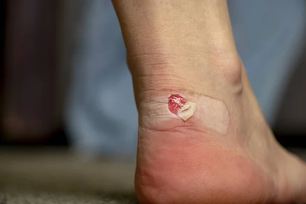A cracked, terrible blister on the heels of a young white-skinned girl after wearing shoes. Wet bloody painful skin on the leg of a person standing on the floor at home