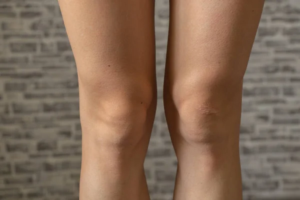 Knees Young White Skinned Girl Scar — Stock Photo, Image