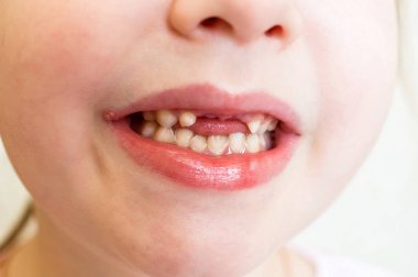 Babys dudaklarında herpes var. Bebek kız eksik ön dişler ile bir gülümseme gösterir. Tedavi merhem. Seçici odak