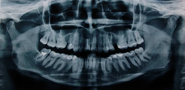 人类牙齿的X光照片 — 图库照片