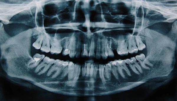 Rentgen Lidských Zubů — Stock fotografie
