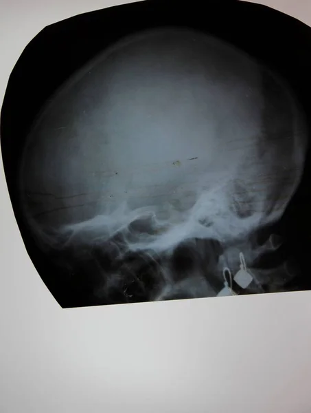 Röntgenfoto Van Menselijke Schedel — Stockfoto