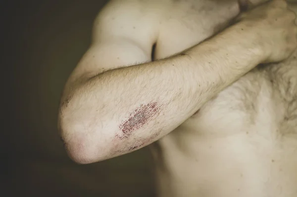 Der junge Mann wurde beim Sport verletzt. — Stockfoto