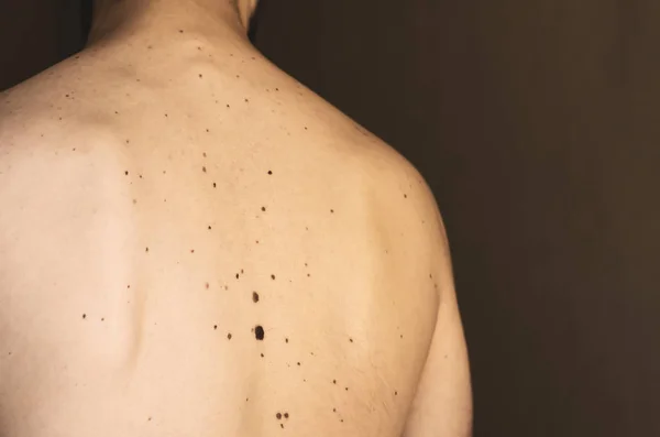 Moles on the back of a man. — Stock Photo, Image